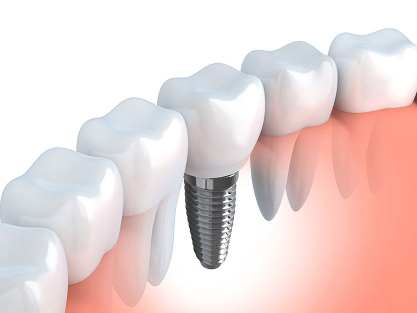 Có nên làm răng Implant không là câu hỏi của nhiều khách hàng