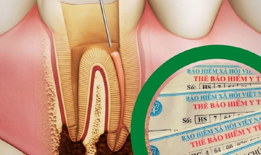 Lấy tủy răng có được bảo hiểm y tế không?