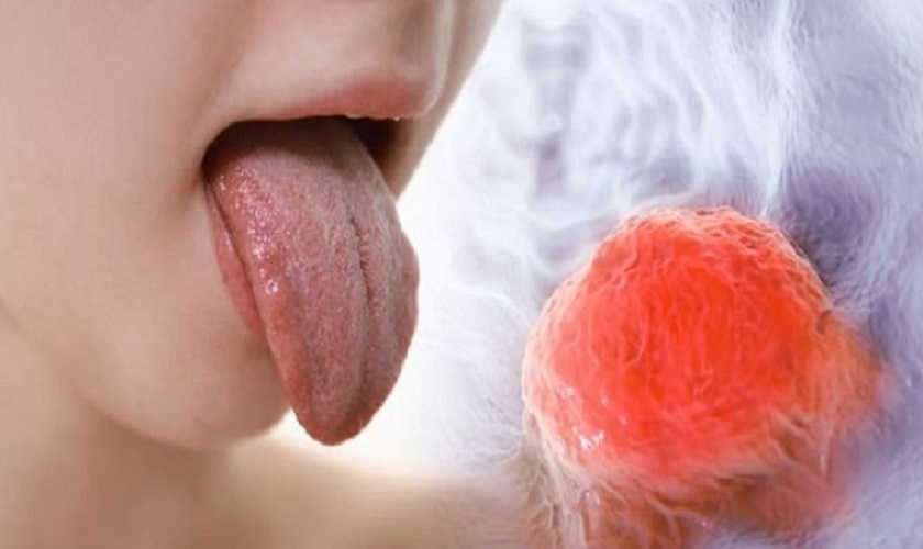 Viêm họng trắng là gì và nguyên nhân gây ra viêm họng trắng?
