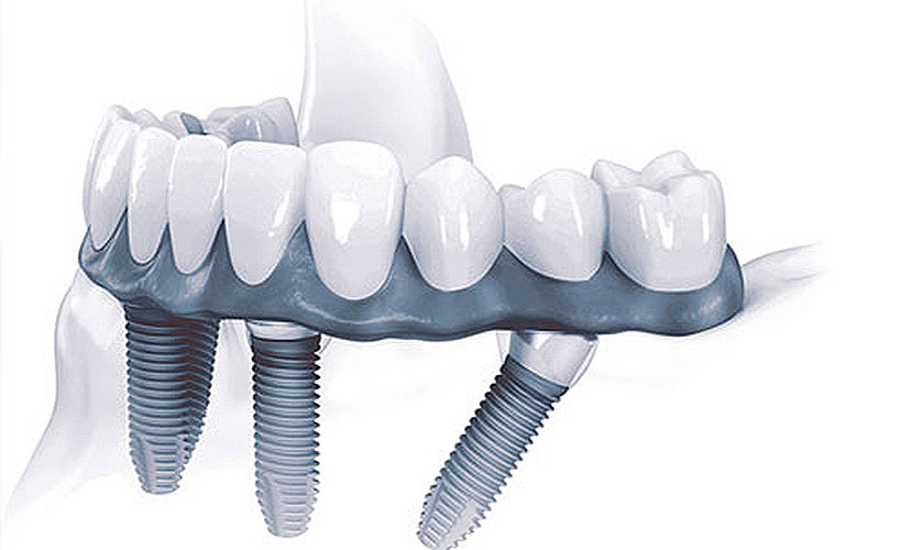 Có nên trồng răng Implant giá rẻ không cần phải dựa vào mức giá chung trên thị trường