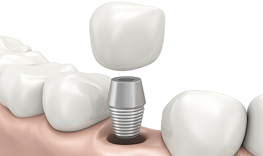 Nha khoa Nhân Tâm là một địa chỉ trồng răng implant tại Việt Nam uy tín