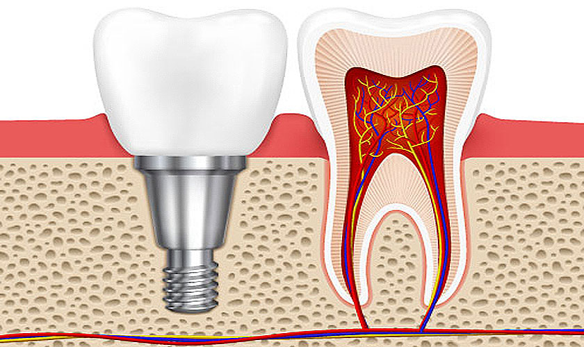 Trước khi lựa chọn trồng răng implant tại tphcm, bạn cần tìm hiểu về giá trồng răng Implant