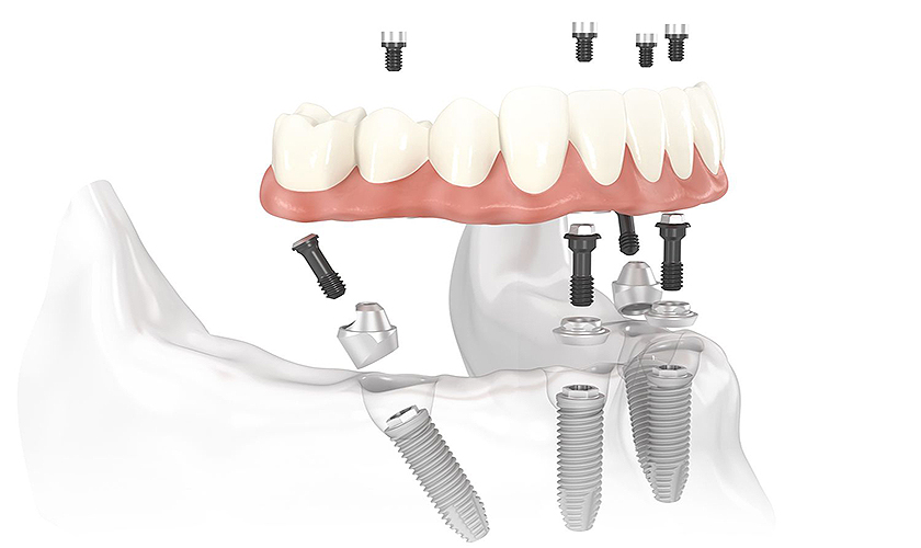 Nha khoa Nhân Tâm là một địa chỉ trồng răng implant tốt, có giá cạnh tranh tại tphcm uy tín