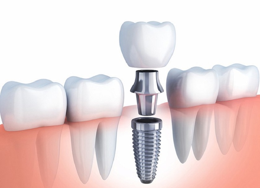 Trồng răng Implant