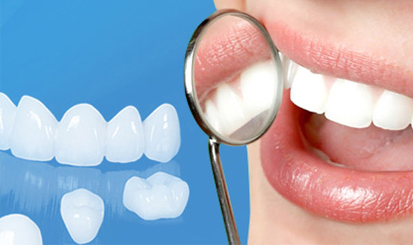 Nên sử dụng răng toàn sứ hay sứ kim loại?