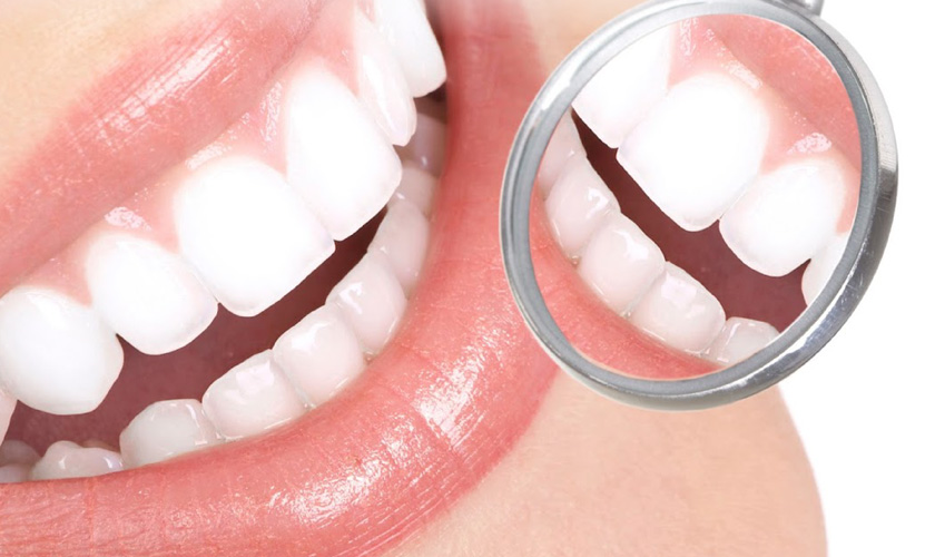 Răng toàn sứ mang đến vẻ thẩm mỹ toàn diện sau phục hình