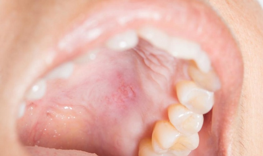 Triệu chứng thường gặp khi nướu răng hàm trên bị sưng