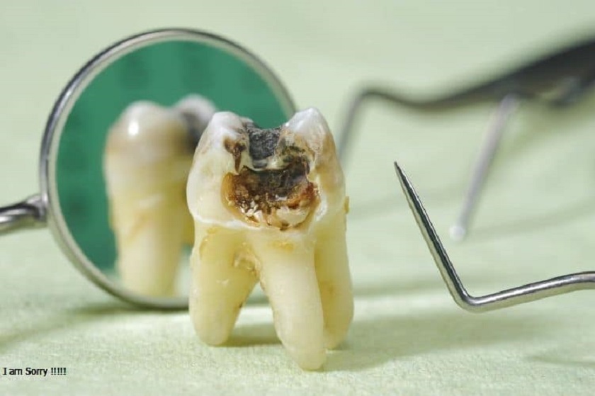 Quy trình nhổ răng cấm tại nha khoa Nhân Tâm