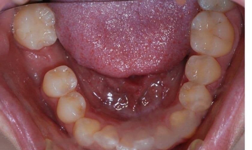 Nhổ răng cấm có ảnh hưởng đến sức khỏe không