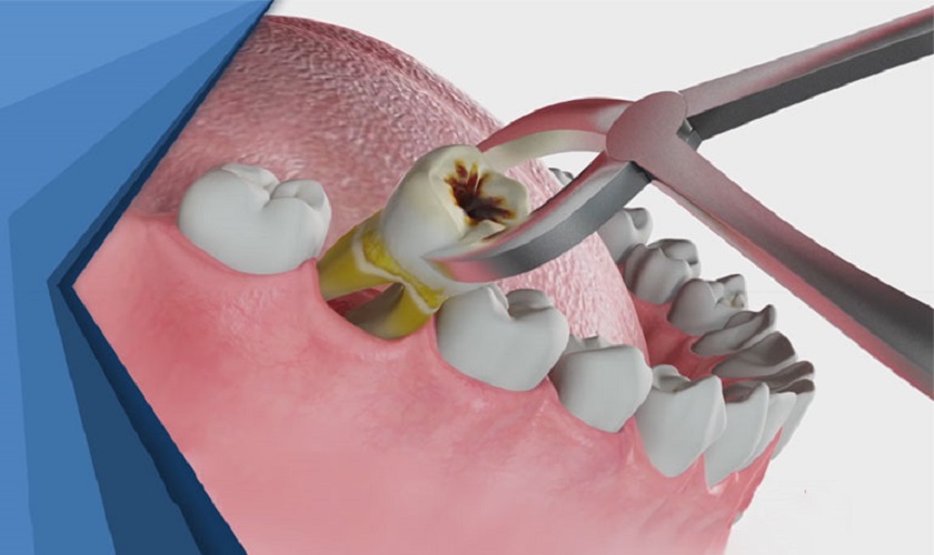 1. Tổng quan về răng cấm