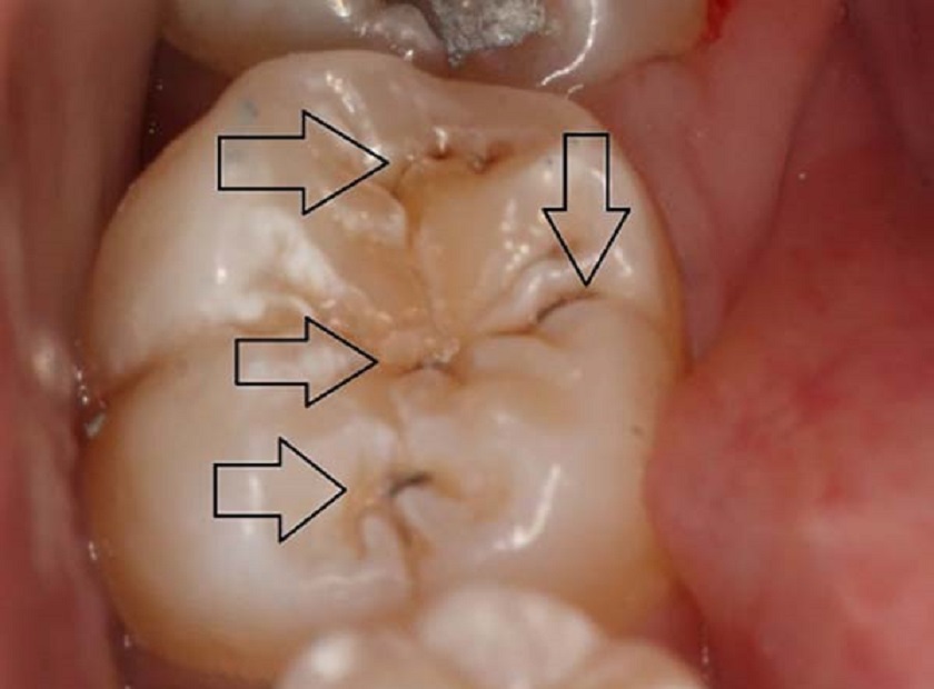 Nhức Răng Hàm Dưới Bên Phải: Nguyên Nhân và Giải Pháp Hiệu Quả