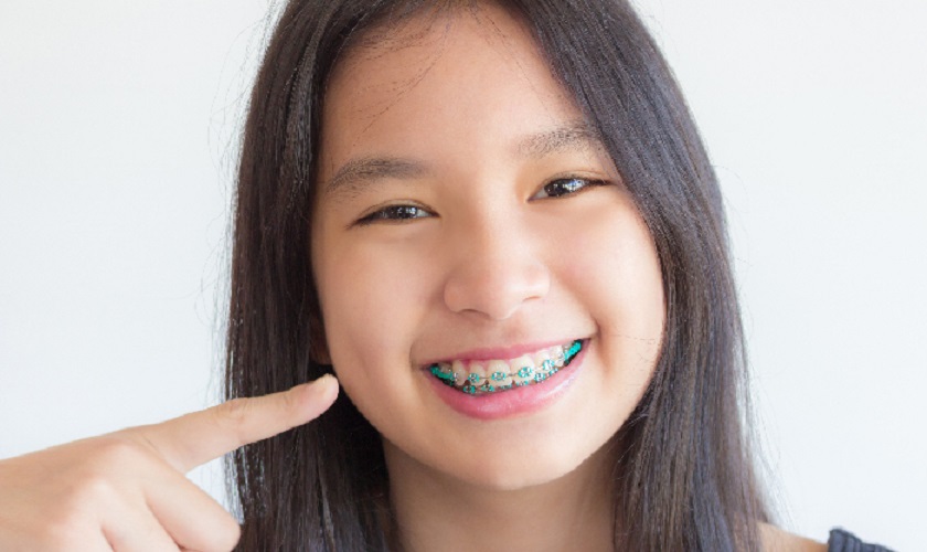 Tìm hiểu những phương pháp niềng răng trẻ em tại nha khoa