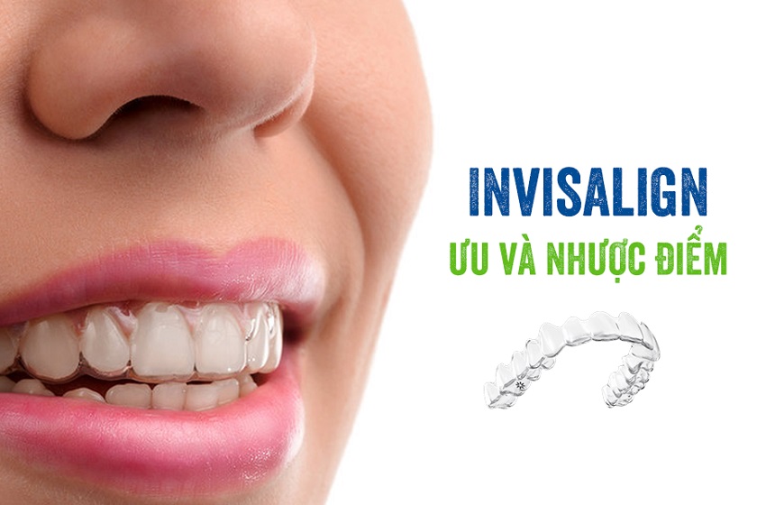 Niềng răng trong suốt Invisalign ưu và nhược điểm