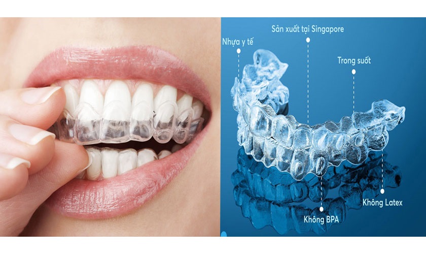 Các yếu tố nào ảnh hưởng đến chi phí niềng răng trong suốt Invisalign