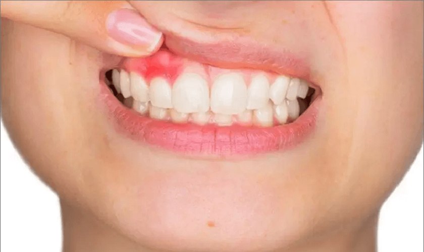 Nổi cục cứng ở lợi có ảnh hưởng nghiêm trọng gì không?