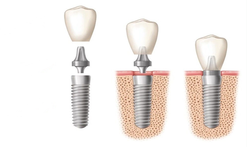 Răng implant gồm răng sứ, Abutment và thân trụ Implant