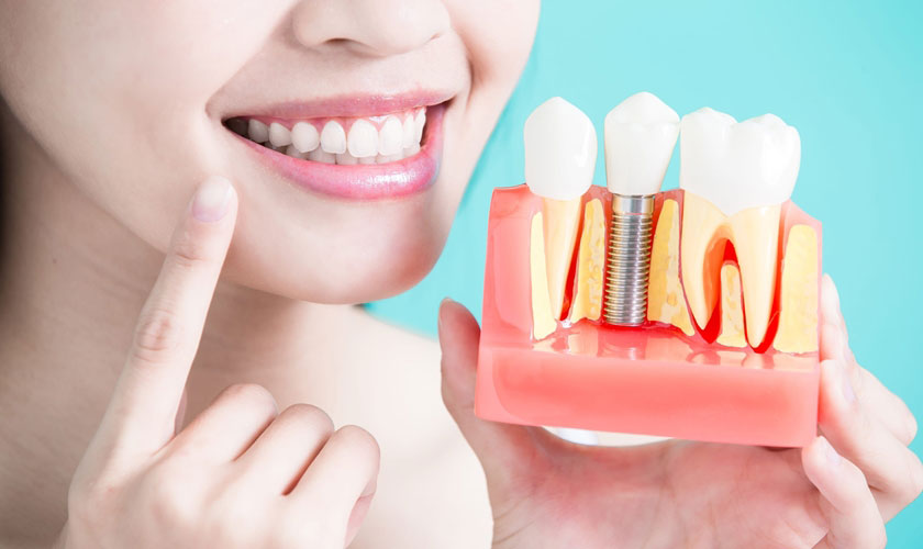 Những ưu điểm nổi bật của phương pháp cấy ghép Implant