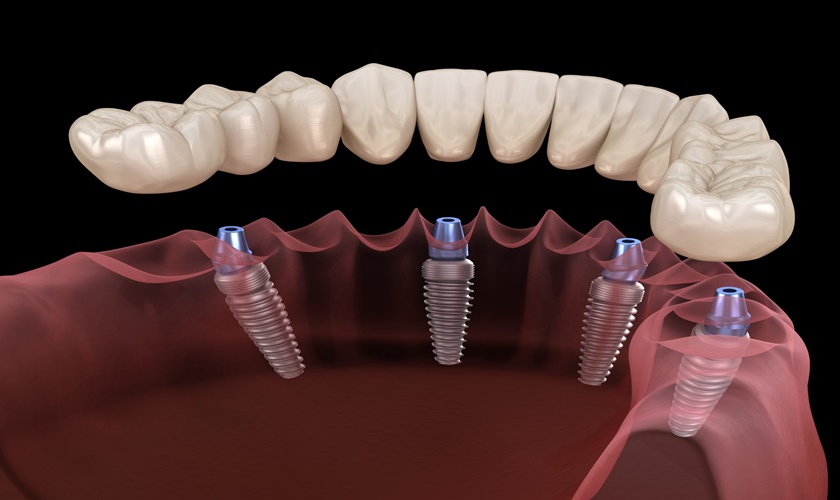 Quy trình trồng răng Implant all on 4 có phức tạp không?