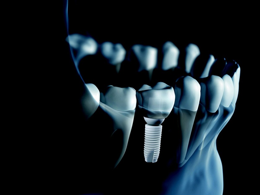 Trụ implant Thụy Sỹ và trụ implant Mỹ tốt nhất