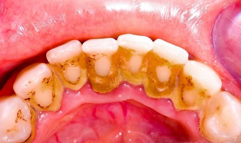 Thức ăn và đồ uống nào có thể gây răng bị đen ở mặt trong?
