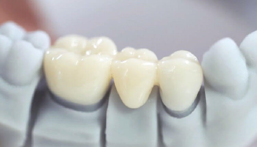 Bọc răng sứ