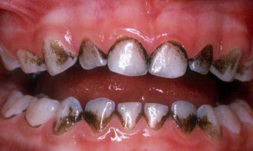 Thói quen vệ sinh răng miệng nào có thể dẫn đến kẽ răng bị đen?

