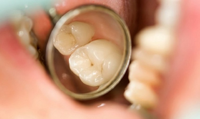 Những nguyên nhân gây ra con sâu đục răng là gì?
