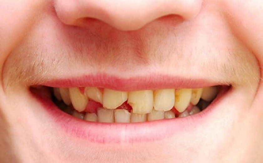 Răng cửa bị mẻ có thể trám được không