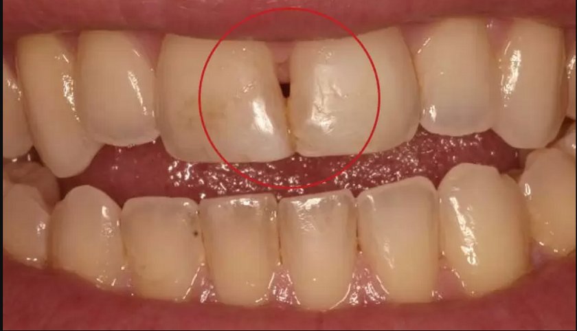 Răng cửa bị sâu bên trong có nguy hiểm không?