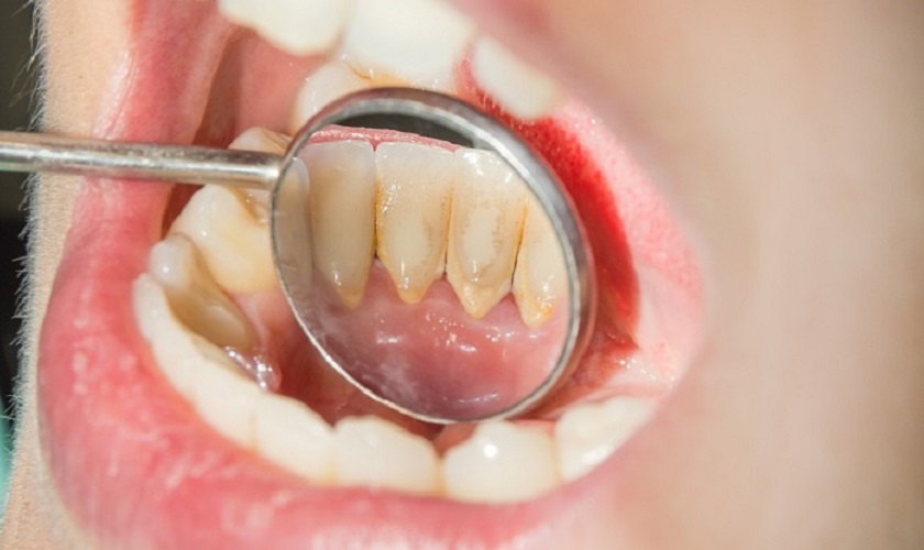 Cách phòng ngừa để tránh bị hư răng cửa là gì?
