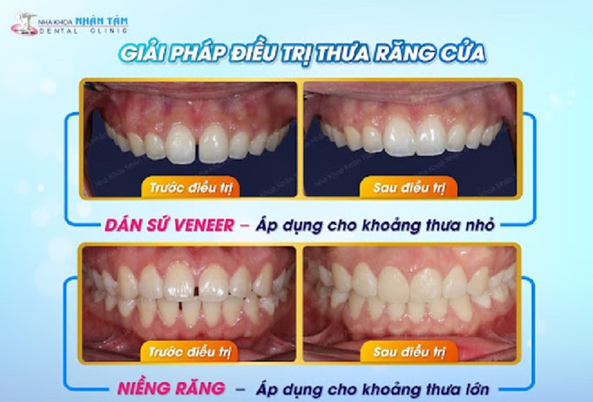 Những phương pháp giúp cải thiện răng cửa bị thưa