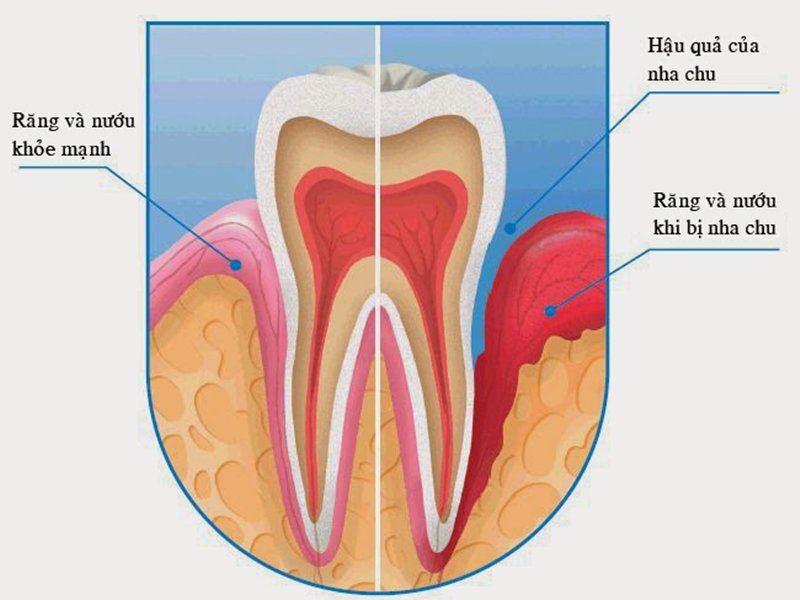 Nướu răng và thân răng bị tổn thương do nha chu