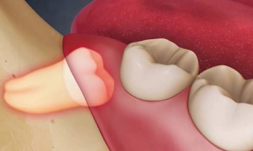 Tìm hiểu răng khôn có nên nhổ không và nên lưu ý điều gì?