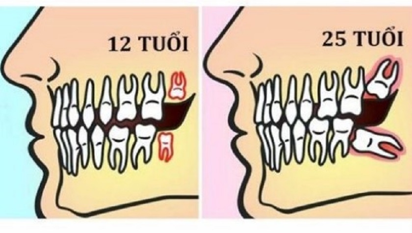 Bị đau do mọc răng khôn nên làm gì