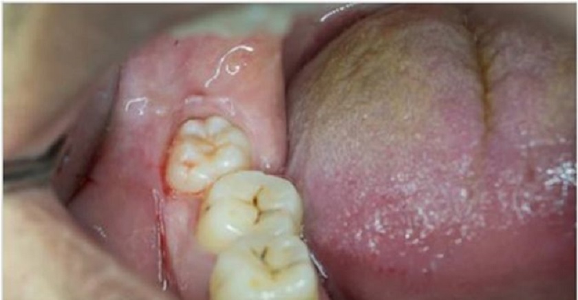 Nhổ răng khôn không đau tại nha khoa Nhân Tâm