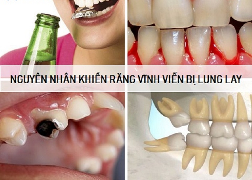 Vì sao người trưởng thành lại bị lung lay răng