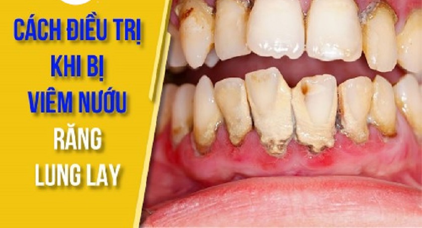 Răng bị lung lay nên chữa thế nào