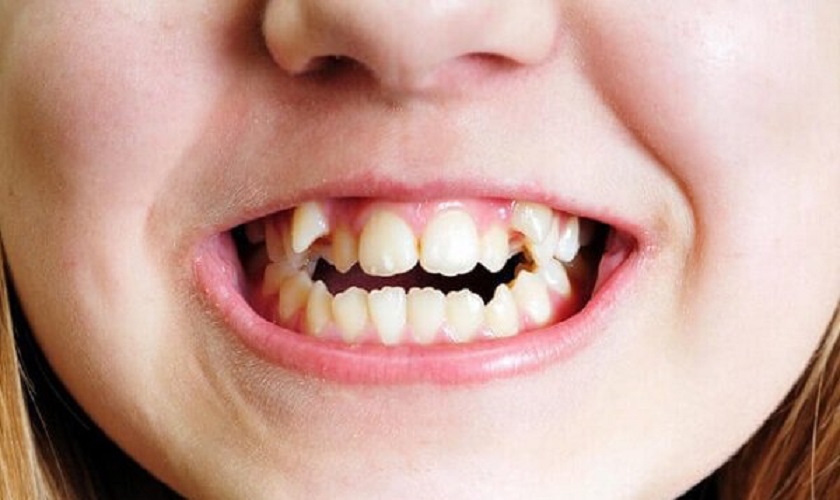 Làm thế nào để xác định rằng mình cần nhổ răng mọc lệch hàm trên?
