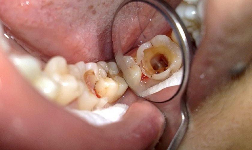 Tại sao nên sử dụng răng sâu có trám được không 