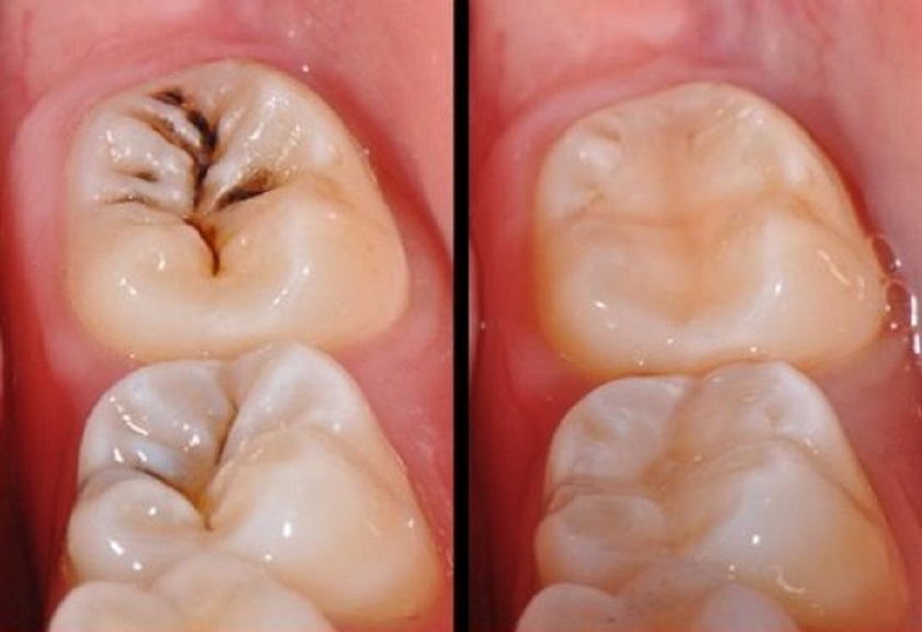 Cách điều trị sâu răng
