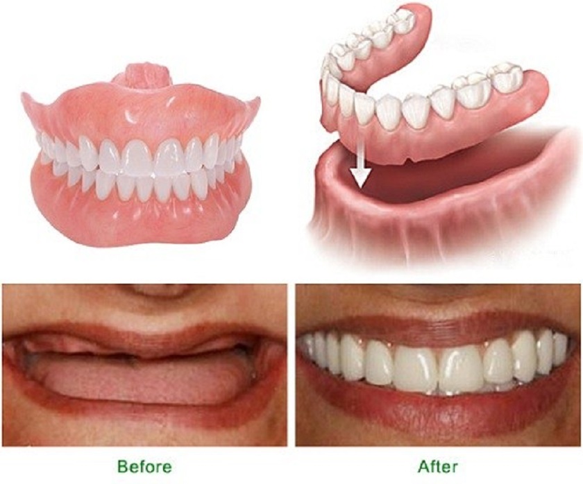 Tìm Hiểu Răng Giả Tháo Lắp: Lợi Ích và Quy Trình Sử Dụng Tìm Hiểu Răng Giả Tháo Lắp: Lợi Ích và Quy Trình Sử Dụng