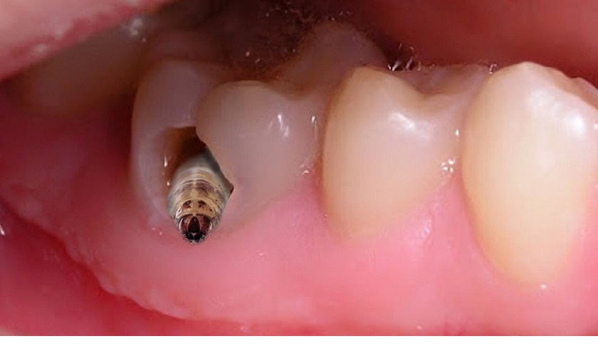 Một số dấu hiệu nhận biết sâu răng hàm có lỗ