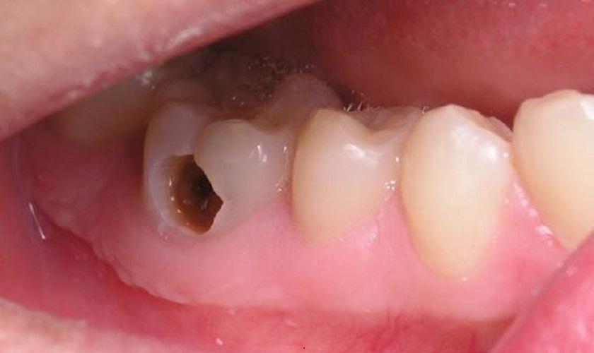 Tác hại của sâu răng hàm có lỗ đối với sức khỏe răng miệng là gì?
