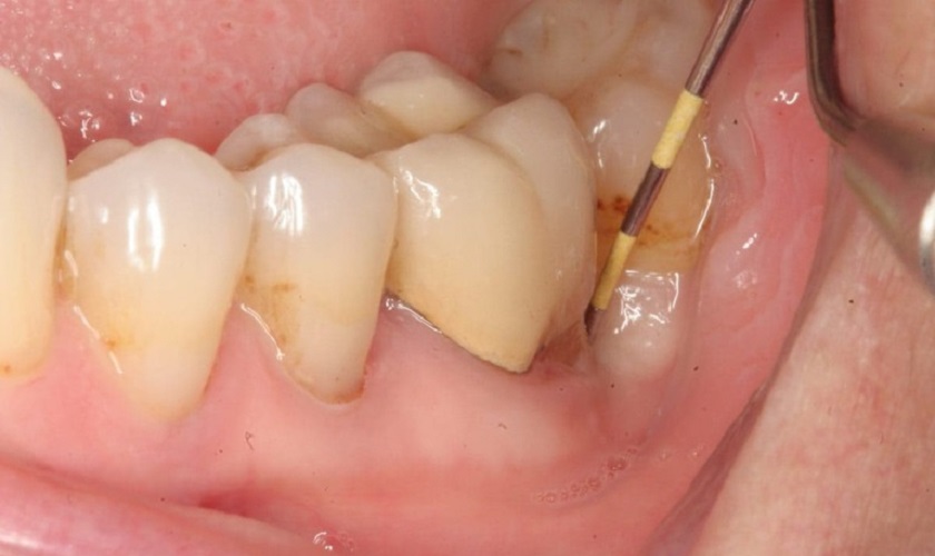 Sưng nướu răng có mủ chữa thế nào? Có triệu chứng ra sao?