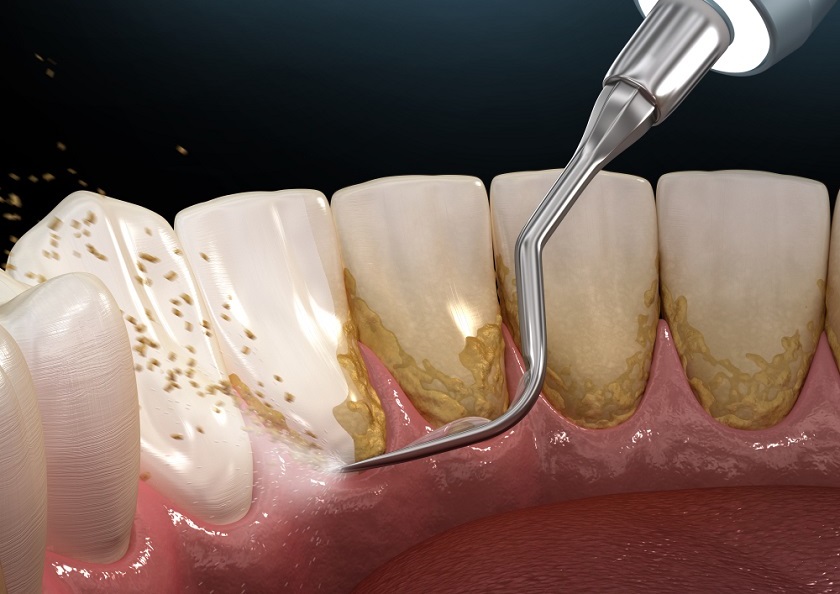 Cạo vôi răng giảm kích thích lên mô nướu