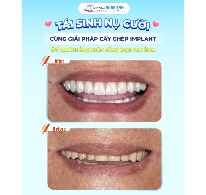 Khách hàng cấy ghép Implant tại Nha khoa Nhân Tâm