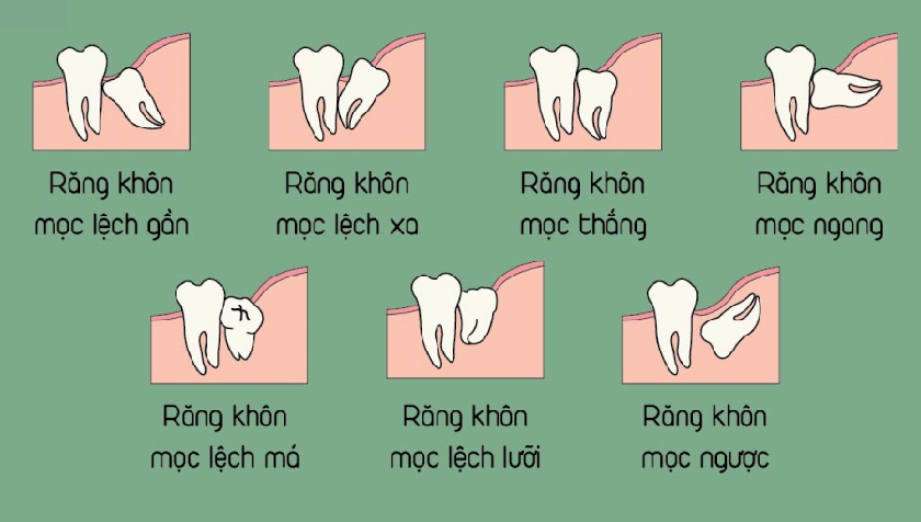 4. Điều Trị Và Giải Pháp Khi Mọc Răng Khôn