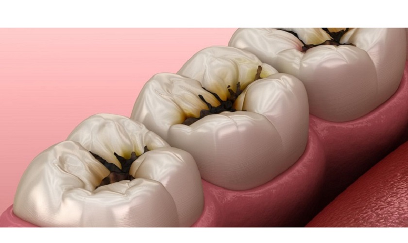 Chia sẻ thông tin về dung dịch chấm sâu răng và cách sử dụng hiệu quả