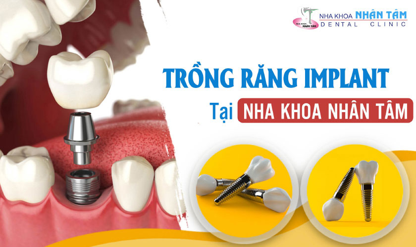 Trồng răng implant tại nha khoa Nhân Tâm uy tín hàng đầu