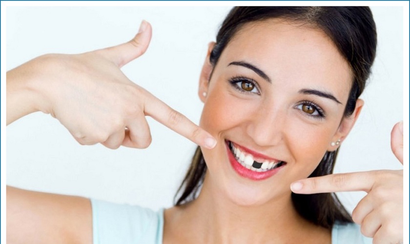 Bí quyết trồng răng Implant tối ưu nhất hiện nay là gì?